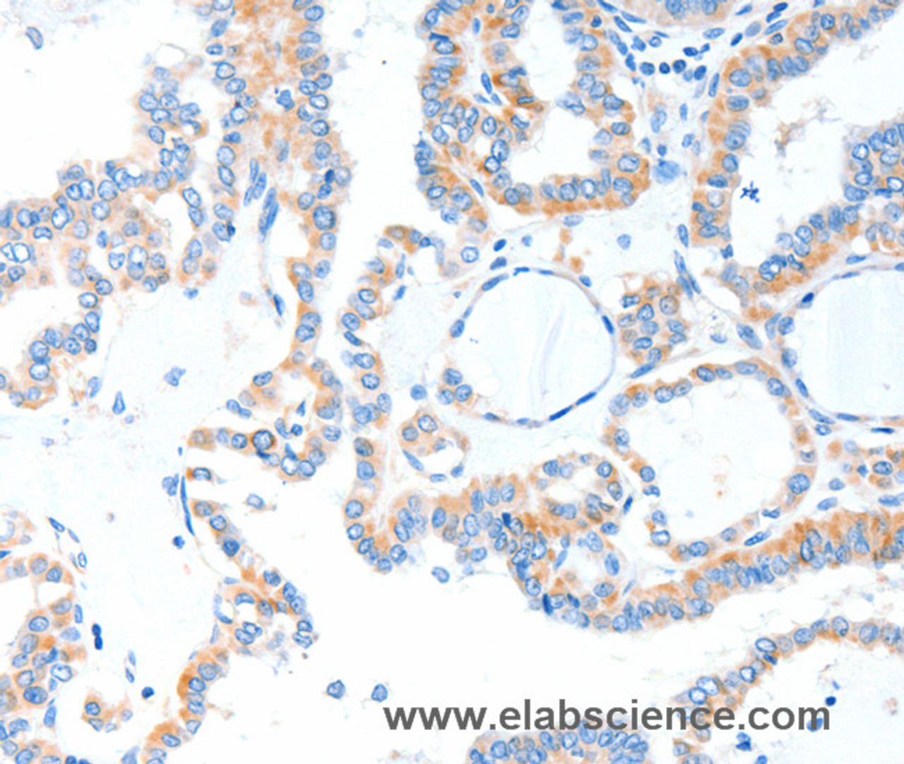 Immunohistochemistry of paraffin-embedded Human thyroid cancer tissue using TLR2 Polyclonal Antibody at dilution 1:55