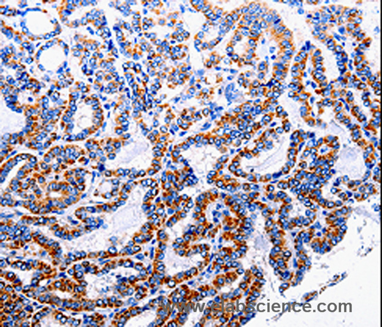 Immunohistochemistry of paraffin-embedded Human thyroid cancer tissue using NFκB-p105 Polyclonal Antibody at dilution 1:40