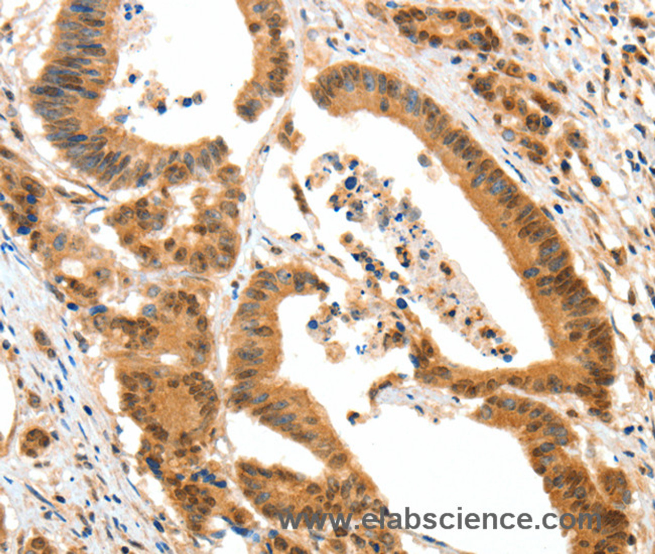 Immunohistochemistry of paraffin-embedded Human colon cancer tissue using HTR3A Polyclonal Antibody at dilution 1:50