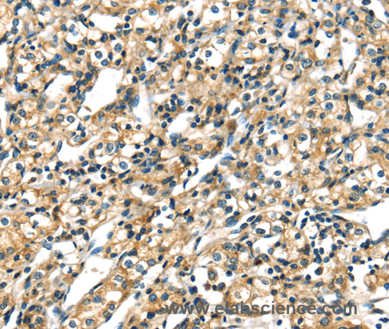 Immunohistochemistry of paraffin-embedded Human prostate cancer tissue using CK-17 Polyclonal Antibody at dilution 1:40