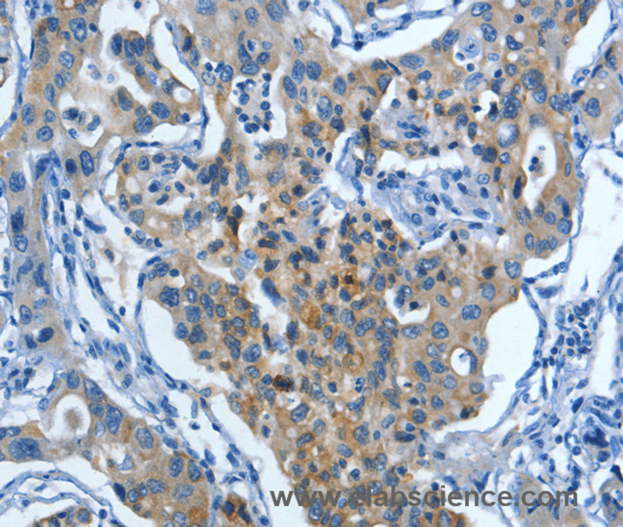 Immunohistochemistry of paraffin-embedded Human lung cancer tissue using MUC15 Polyclonal Antibody at dilution 1:50