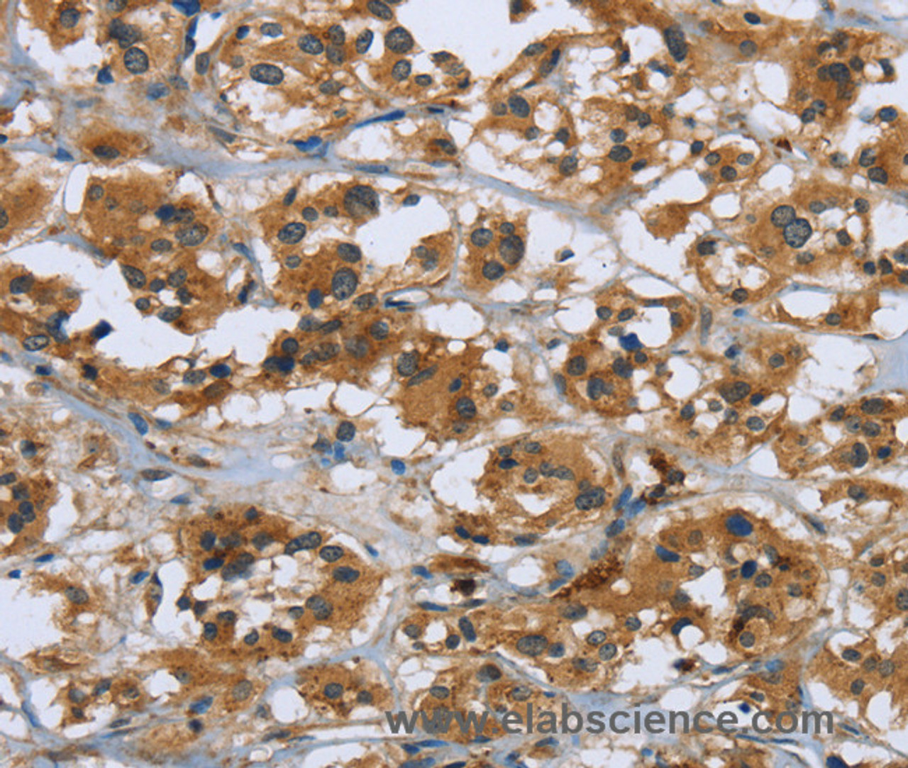Immunohistochemistry of paraffin-embedded Human thyroid cancer using RAP1B Polyclonal Antibody at dilution of 1:50