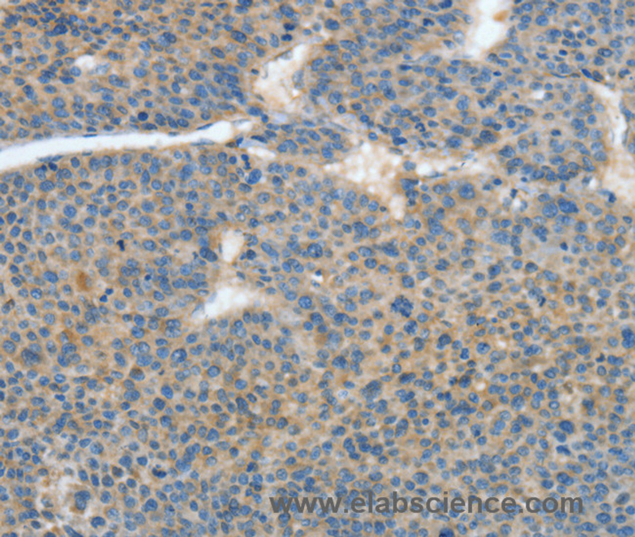 Immunohistochemistry of paraffin-embedded Human liver cancer tissue using ATP4B Polyclonal Antibody at dilution 1:40