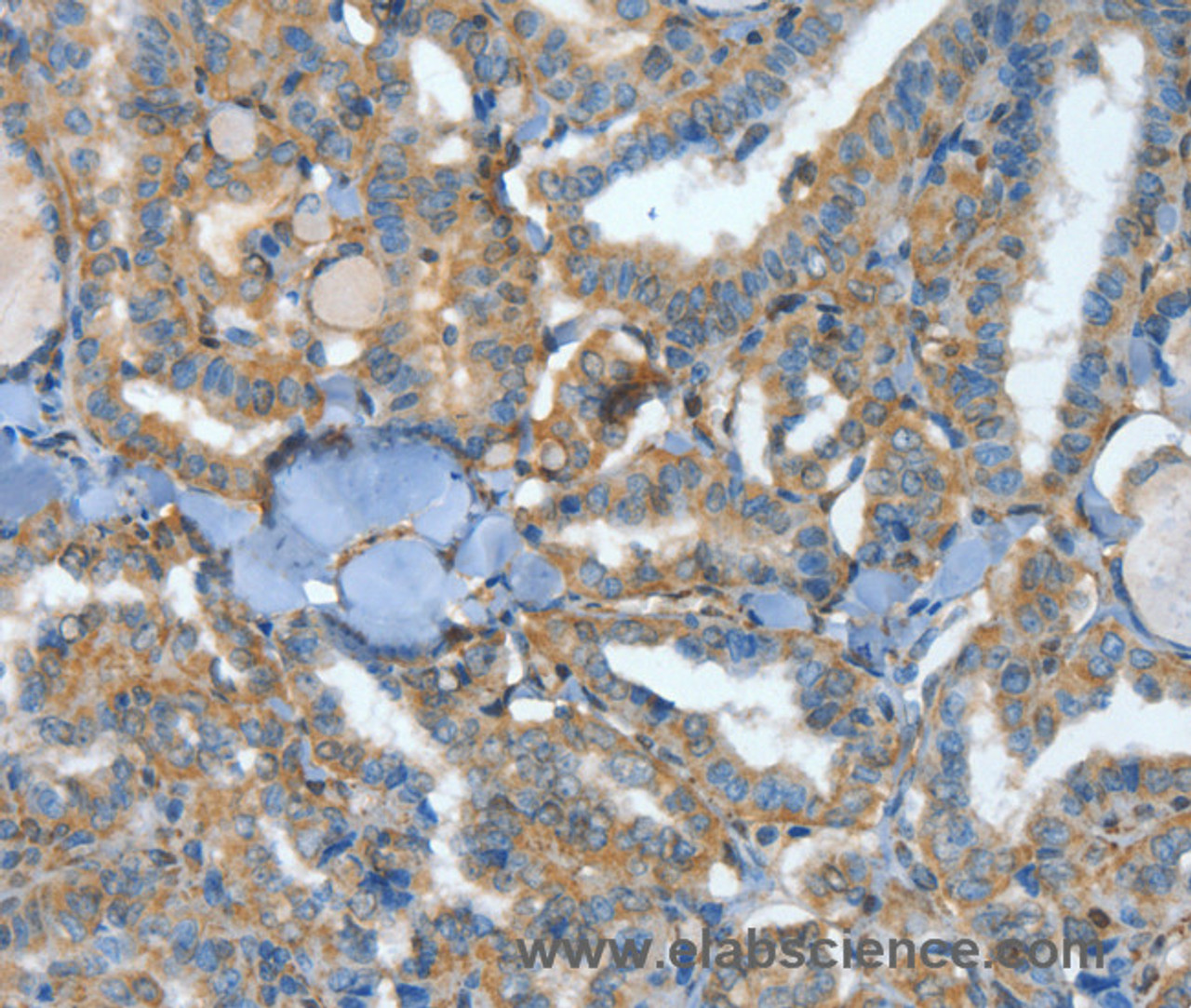 Immunohistochemistry of paraffin-embedded Human thyroid cancer tissue using ATP4B Polyclonal Antibody at dilution 1:40