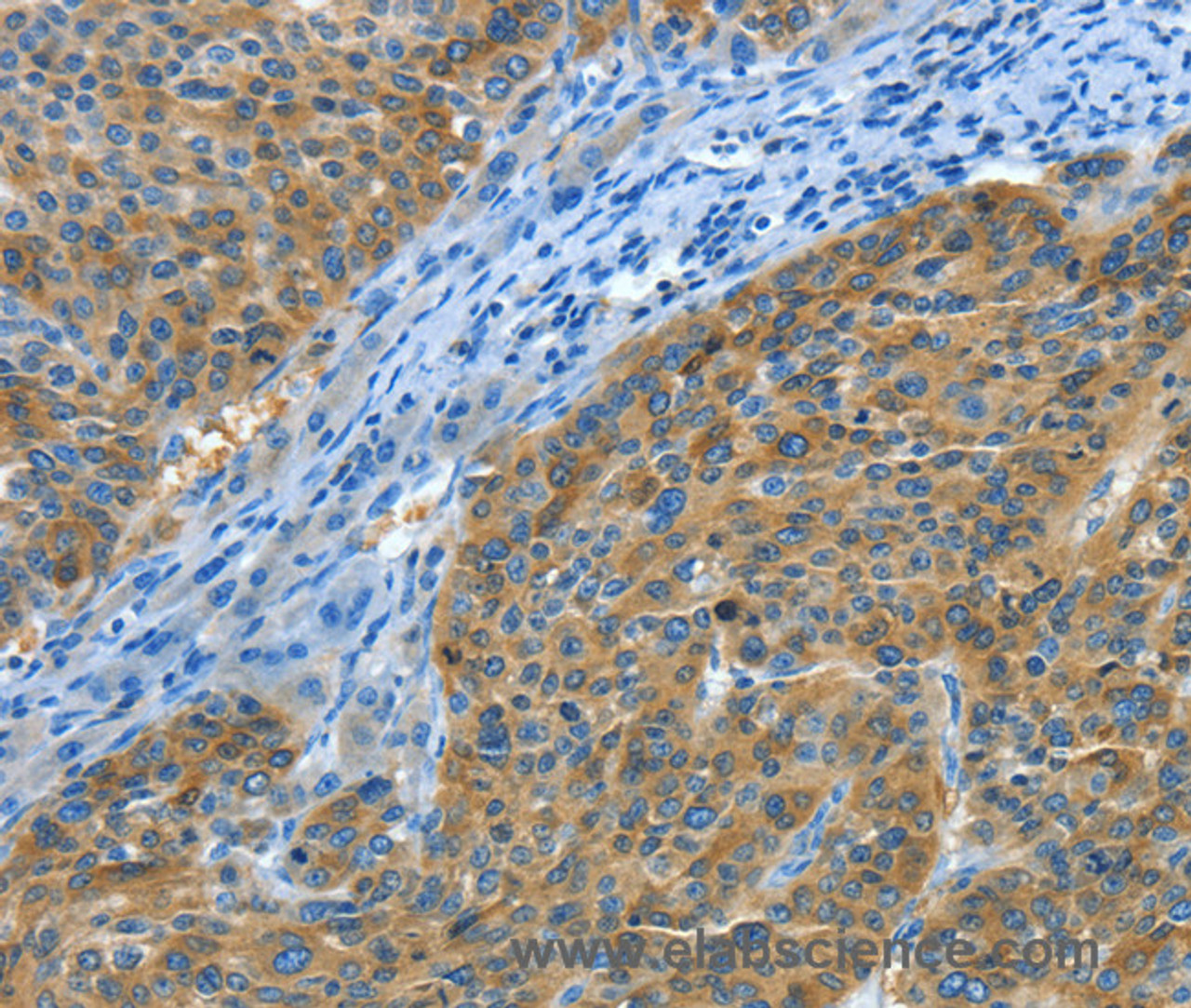 Immunohistochemistry of paraffin-embedded Human liver cancer tissue using Amphiphysin II Polyclonal Antibody at dilution 1:30