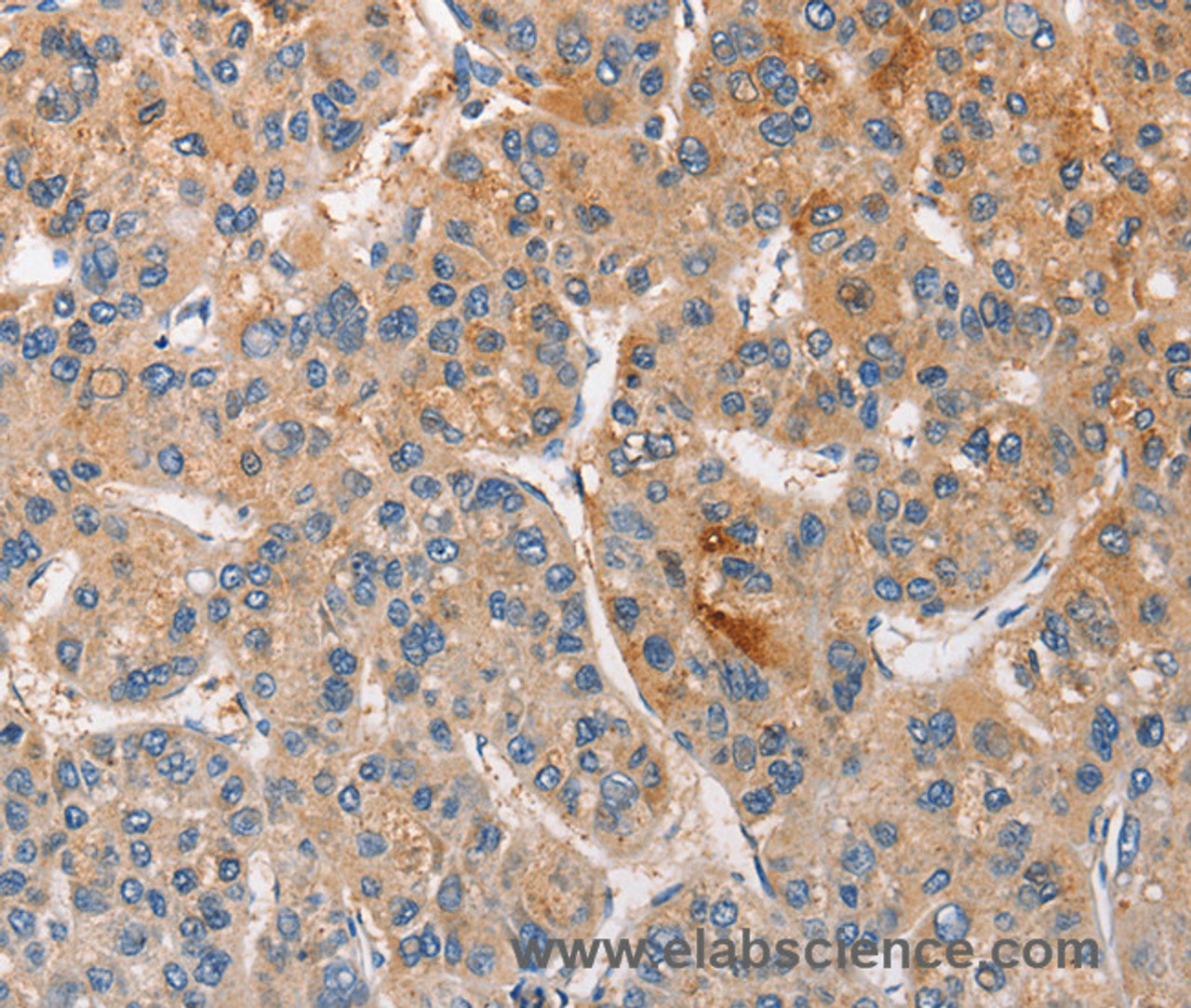 Immunohistochemistry of paraffin-embedded Human liver cancer tissue using CCL4 Polyclonal Antibody at dilution 1:40