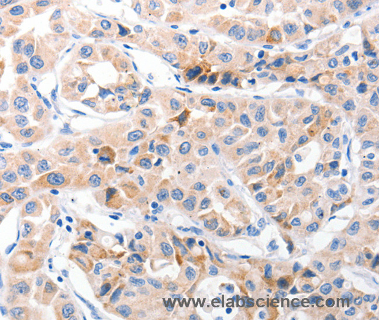 Immunohistochemistry of paraffin-embedded Human lung cancer using CDK7 Polyclonal Antibody at dilution of 1:30