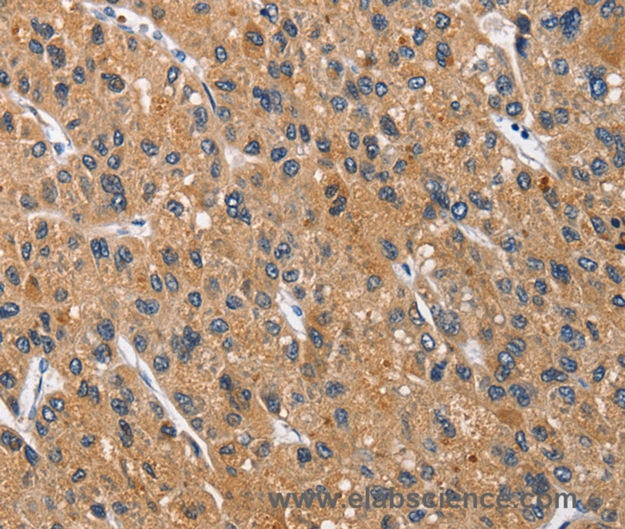 Immunohistochemistry of paraffin-embedded Human liver cancer tissue using CEACAM3 Polyclonal Antibody at dilution 1:70