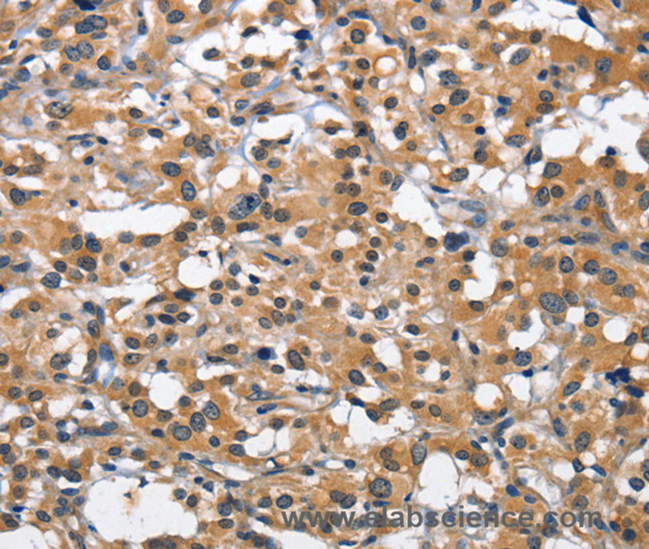 Immunohistochemistry of paraffin-embedded Human thyroid cancer tissue using CEACAM3 Polyclonal Antibody at dilution 1:70