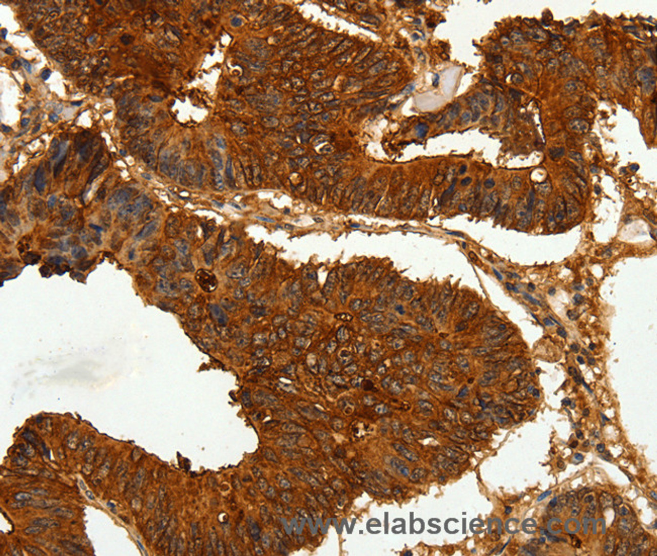 Immunohistochemistry of paraffin-embedded Human colon cancer tissue using CEACAM21 Polyclonal Antibody at dilution 1:60