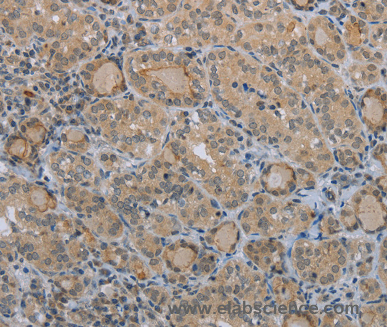 Immunohistochemistry of paraffin-embedded Human thyroid cancer tissue using CLEC1A Polyclonal Antibody at dilution 1:40