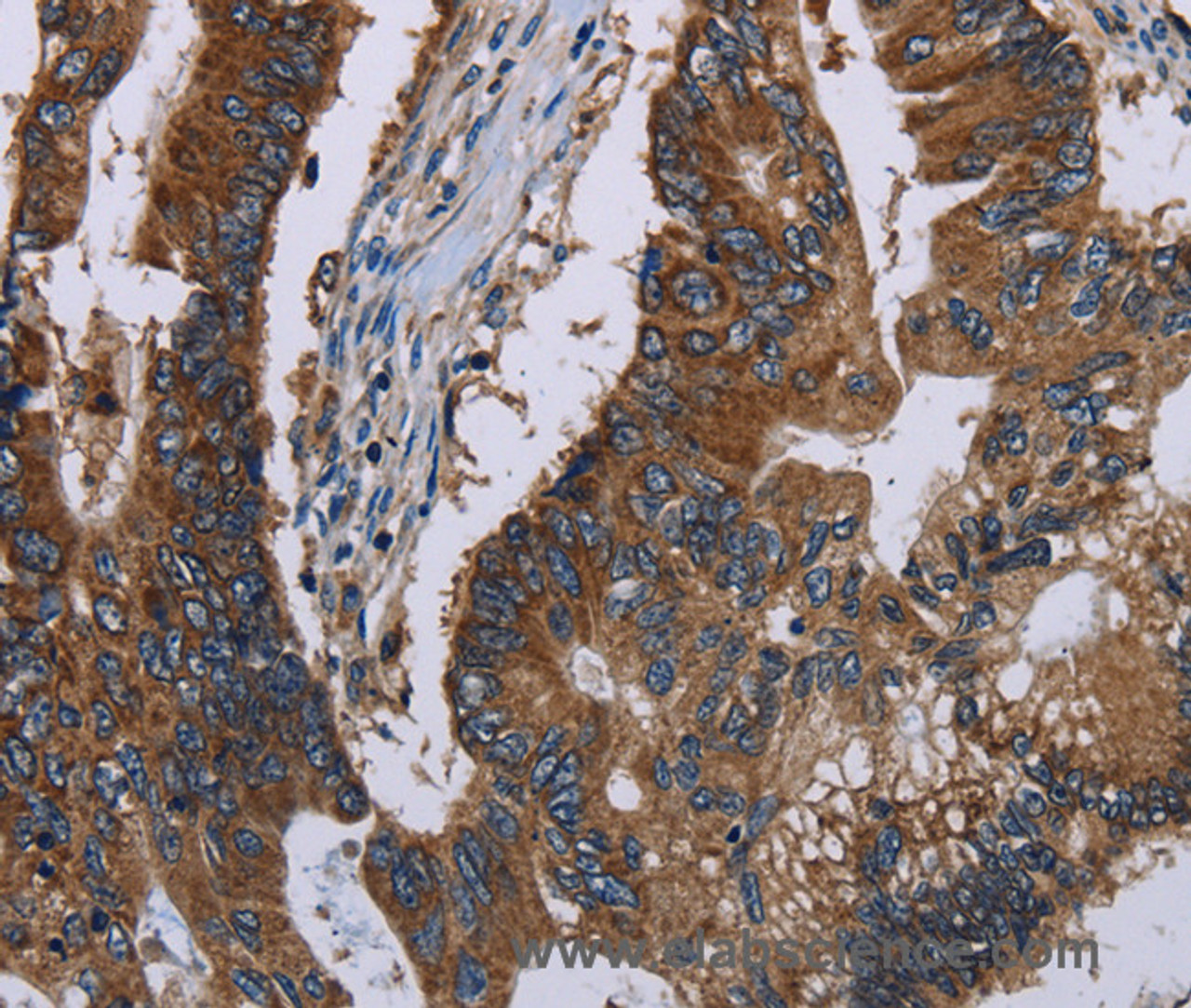 Immunohistochemistry of paraffin-embedded Human colon cancer tissue using CLDND1 Polyclonal Antibody at dilution 1:40