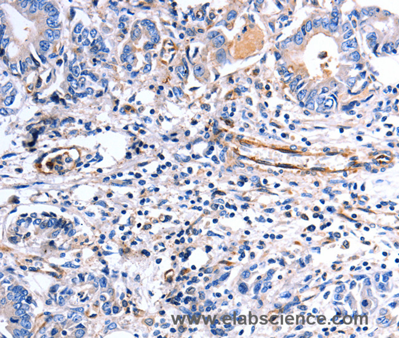 Immunohistochemistry of paraffin-embedded Human stomach cancer using COX11 Polyclonal Antibody at dilution of 1:30