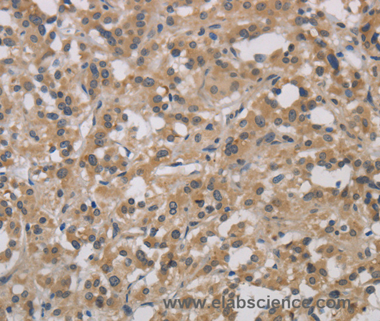 Immunohistochemistry of paraffin-embedded Human thyroid cancer tissue using DCN Polyclonal Antibody at dilution 1:30
