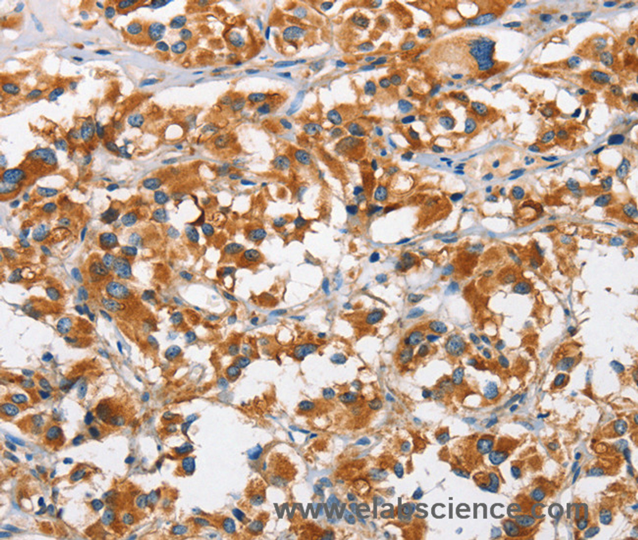 Immunohistochemistry of paraffin-embedded Human thyroid cancer using DKK3 Polyclonal Antibody at dilution of 1:50