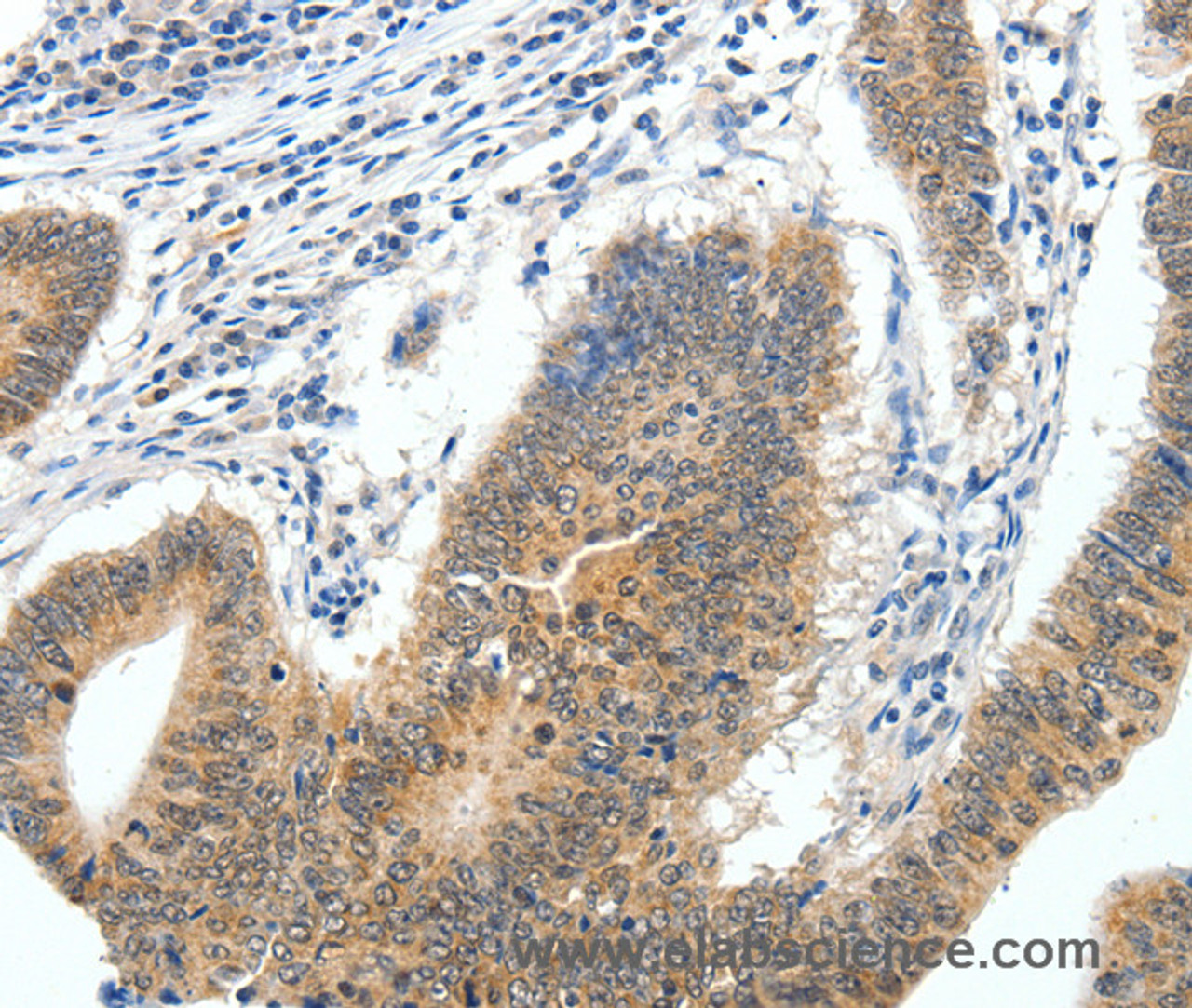 Immunohistochemistry of paraffin-embedded Human colon cancer tissue using ECE2 Polyclonal Antibody at dilution 1:40