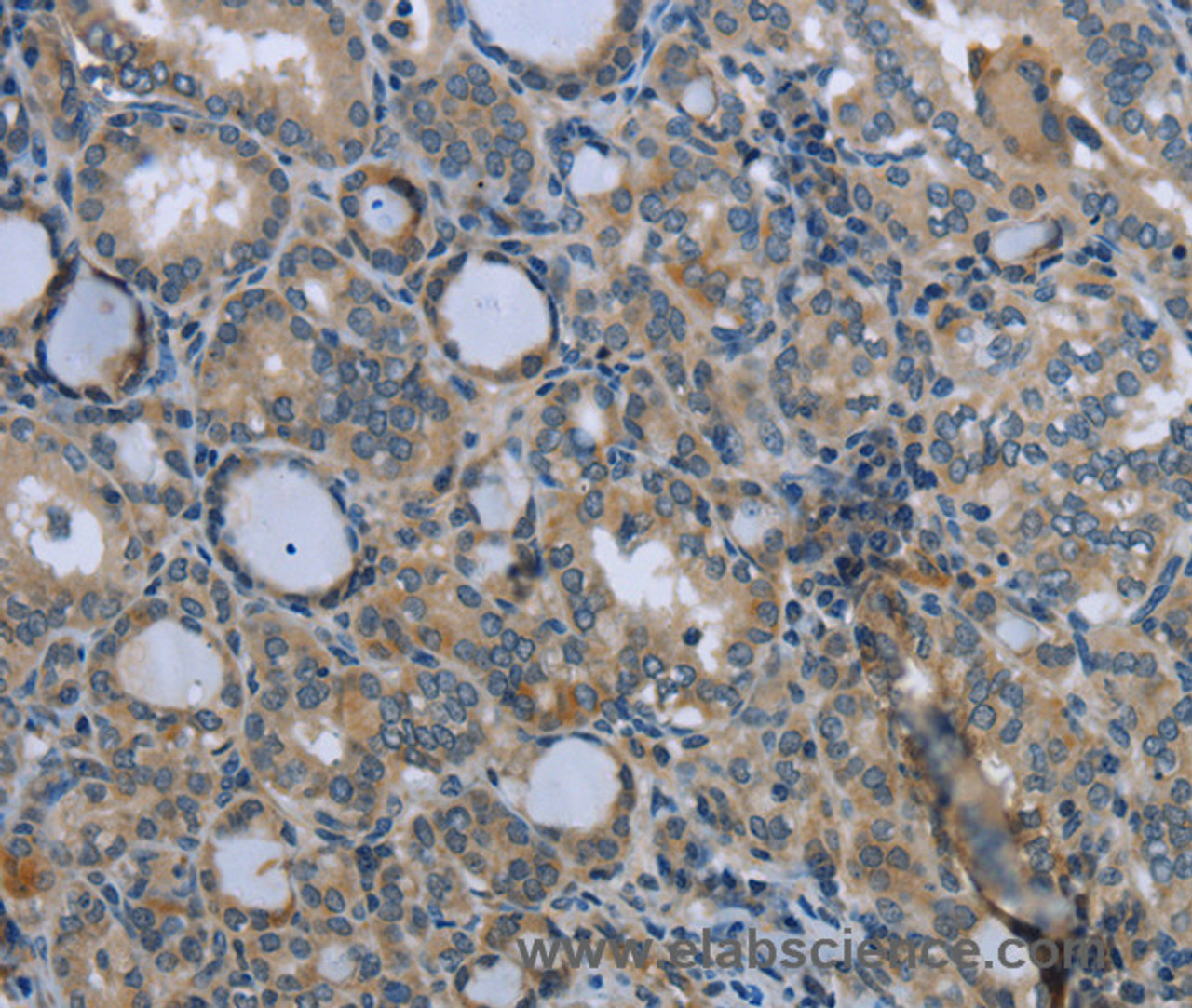Immunohistochemistry of paraffin-embedded Human thyroid cancer tissue using EGFL8 Polyclonal Antibody at dilution 1:40