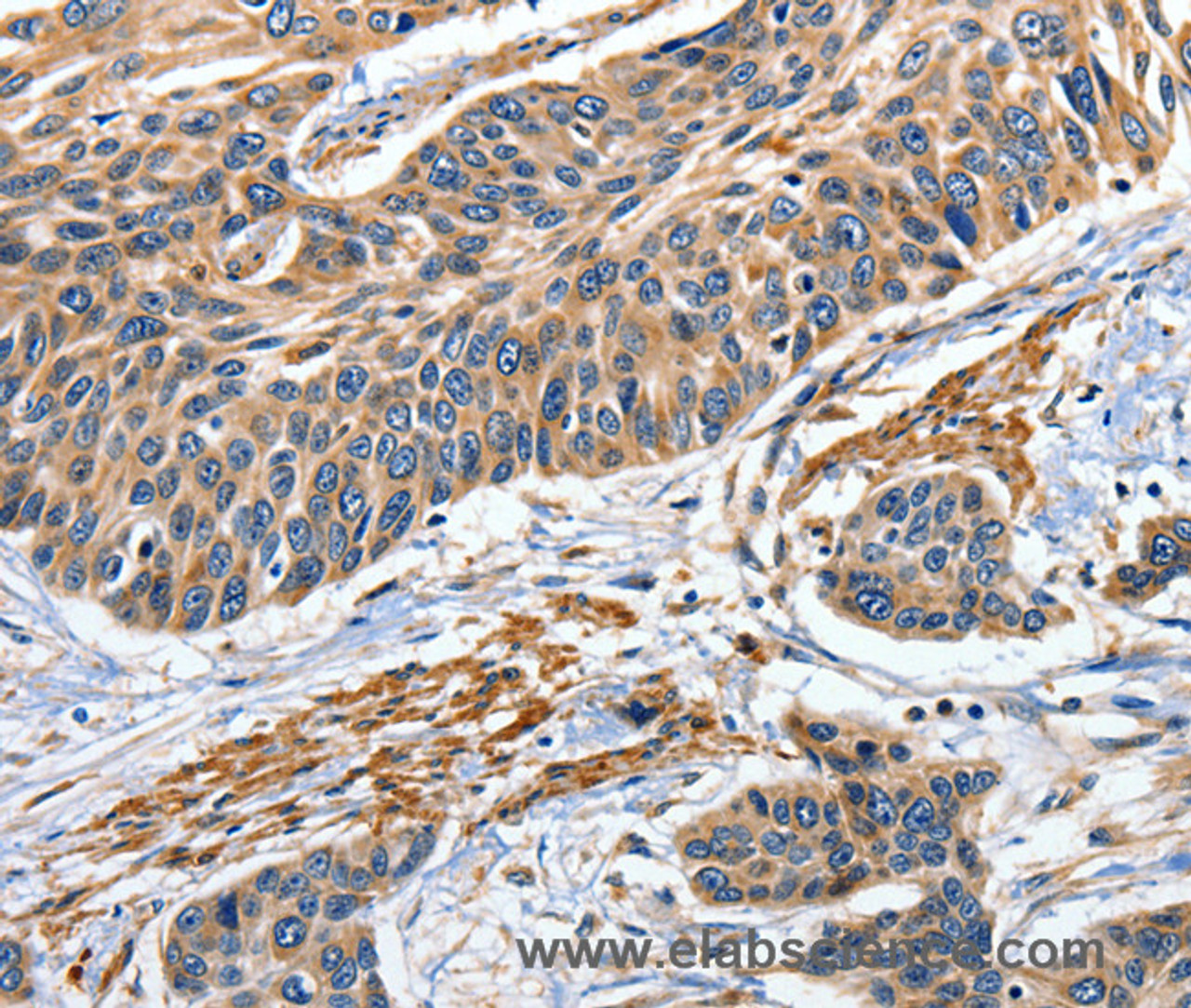 Immunohistochemistry of paraffin-embedded Human esophagus cancer tissue using EFNB2 Polyclonal Antibody at dilution 1:80