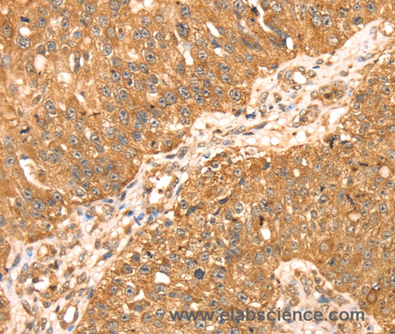 Immunohistochemistry of paraffin-embedded Human breast cancer using ERK 5 Polyclonal Antibody at dilution of 1:35