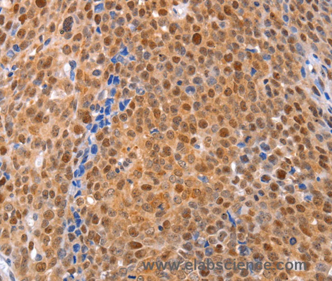 Immunohistochemistry of paraffin-embedded Human ovarian cancer using MKP-2 Polyclonal Antibody at dilution of 1:30