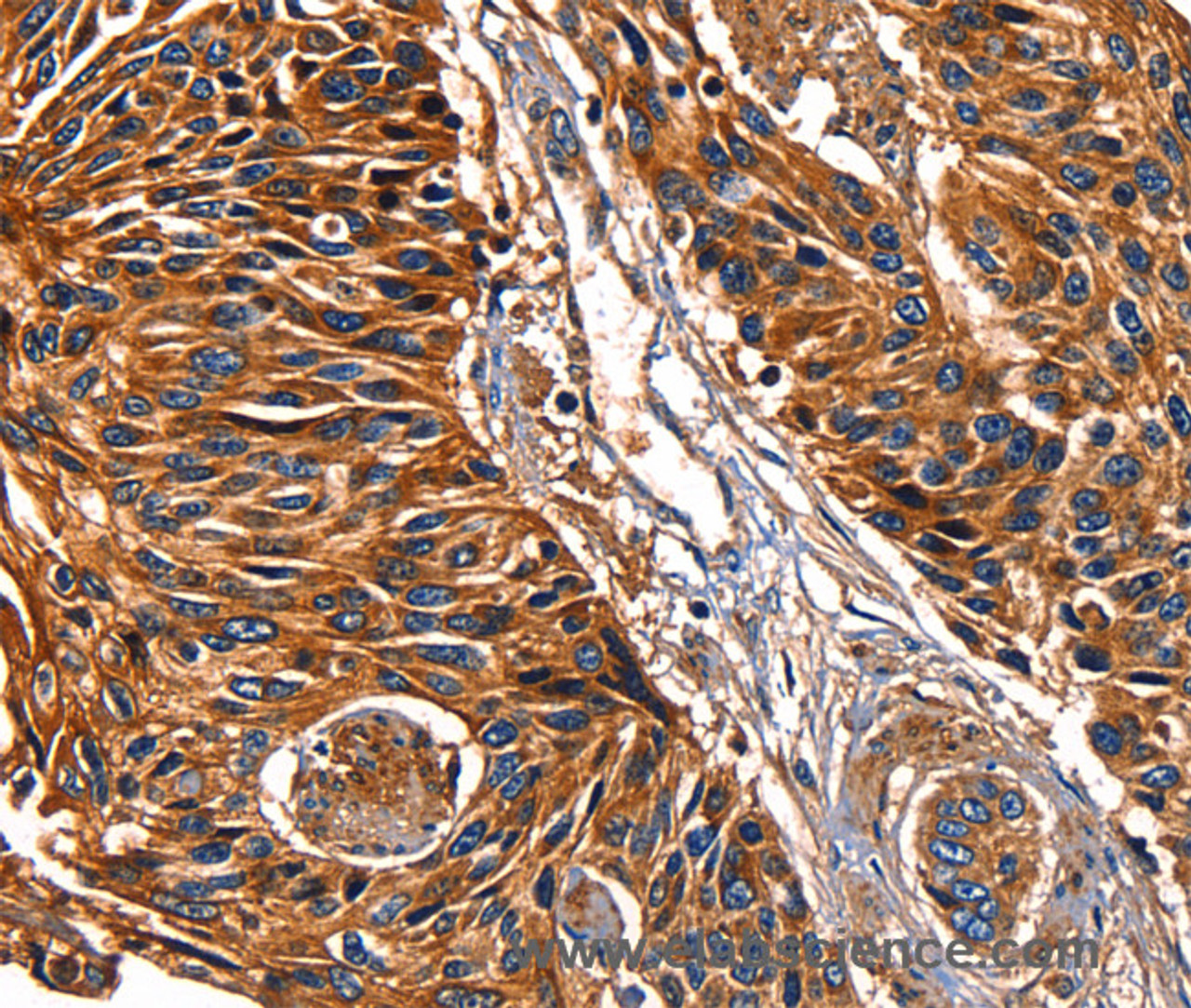 Immunohistochemistry of paraffin-embedded Human esophagus cancer tissue using Galectin 8 Polyclonal Antibody at dilution 1:50
