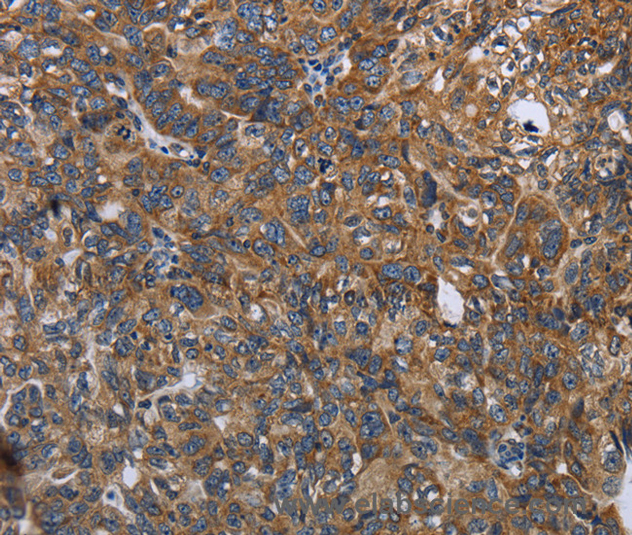 Immunohistochemistry of paraffin-embedded Human ovarian cancer tissue using LGALS2 Polyclonal Antibody at dilution 1:30