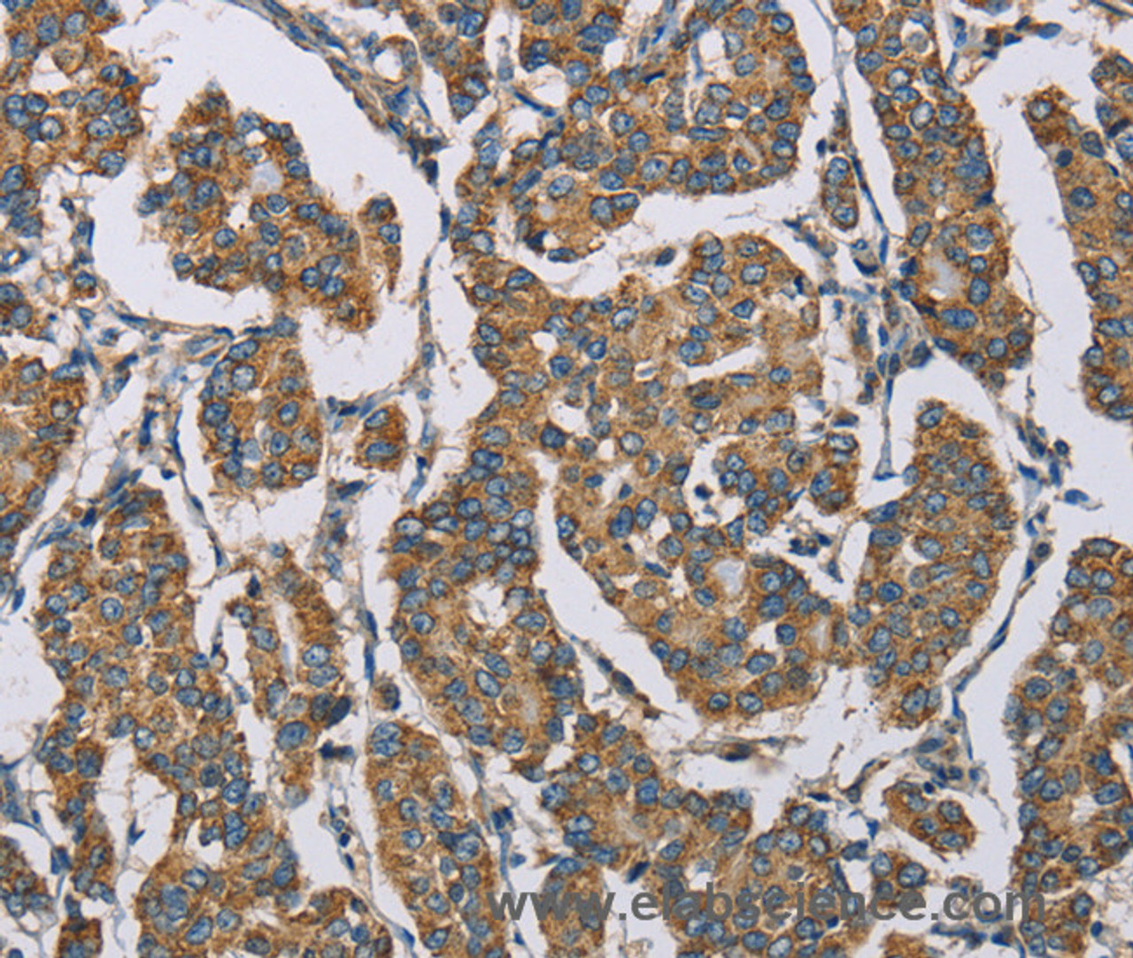 Immunohistochemistry of paraffin-embedded Human breast cancer tissue using HDAC6 Polyclonal Antibody at dilution 1:50