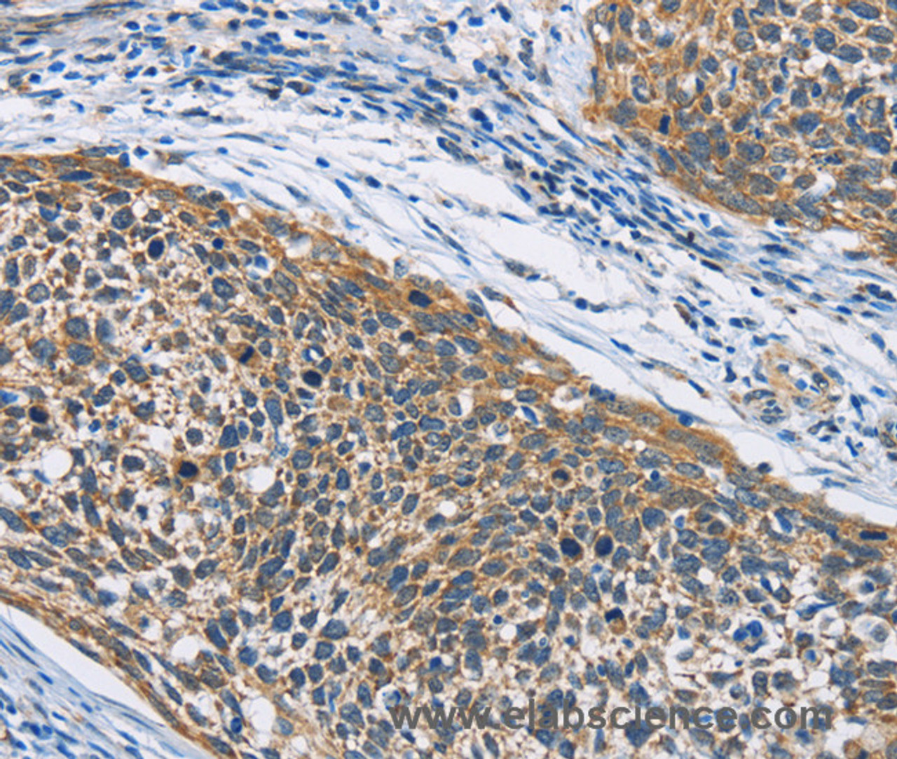 Immunohistochemistry of paraffin-embedded Human cervical cancer tissue using HDAC6 Polyclonal Antibody at dilution 1:50
