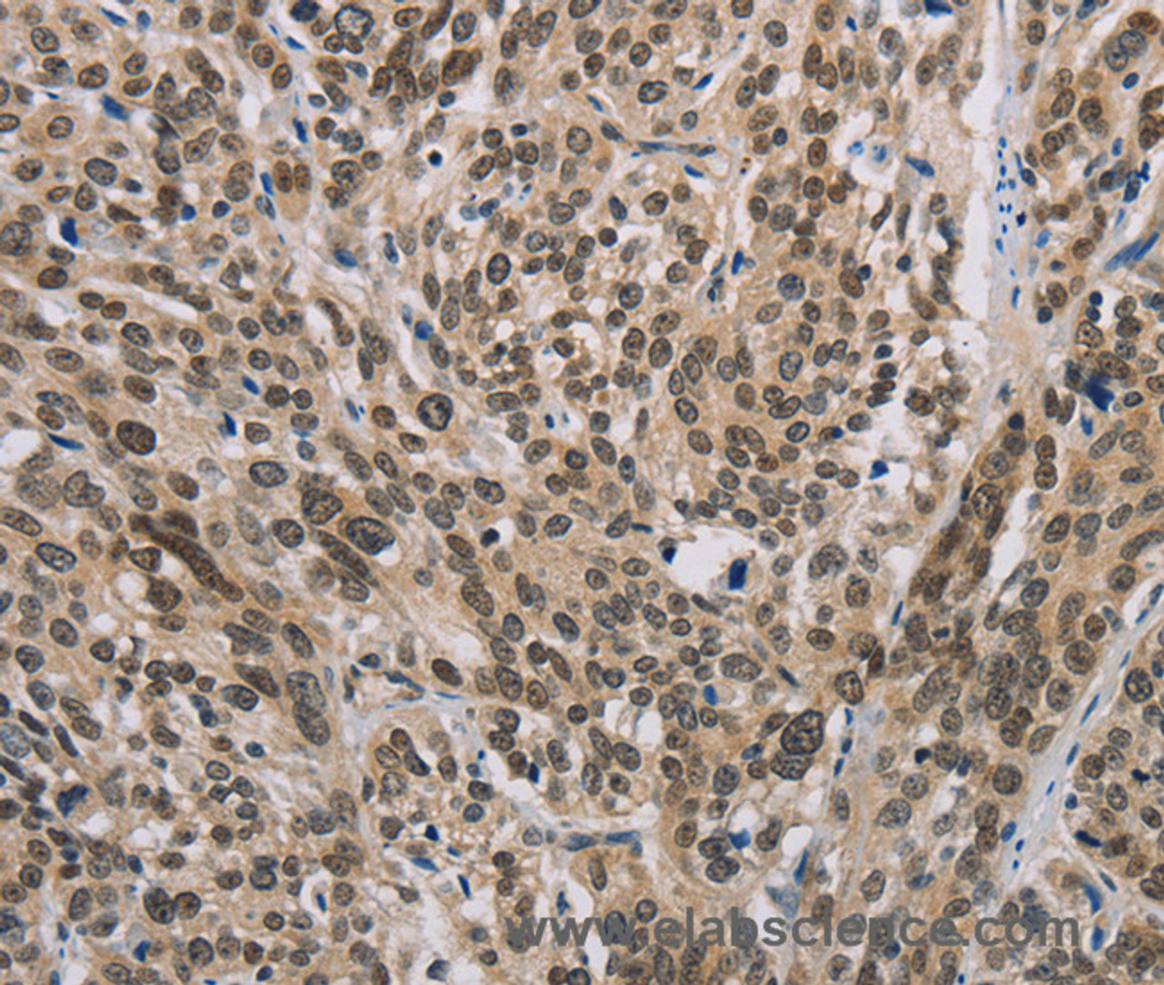 Immunohistochemistry of paraffin-embedded Human esophagus cancer using IRF9 Polyclonal Antibody at dilution of 1:50