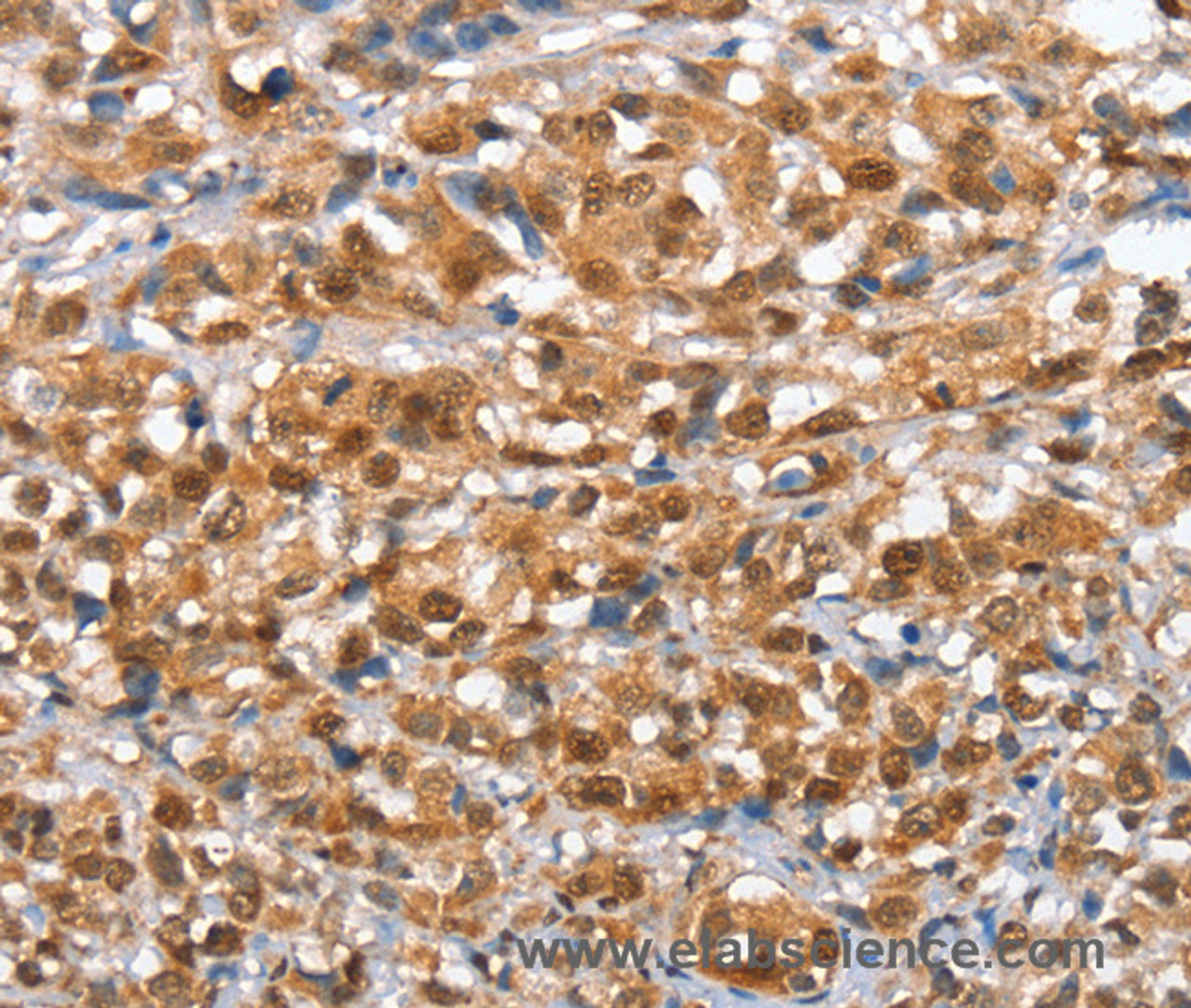Immunohistochemistry of paraffin-embedded Human esophagus cancer tissue using IRAK3 Polyclonal Antibody at dilution 1:50