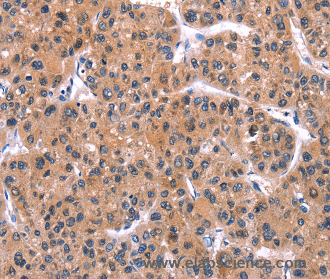 Immunohistochemistry of paraffin-embedded Human liver cancer tissue using IRS1 Polyclonal Antibody at dilution 1:30