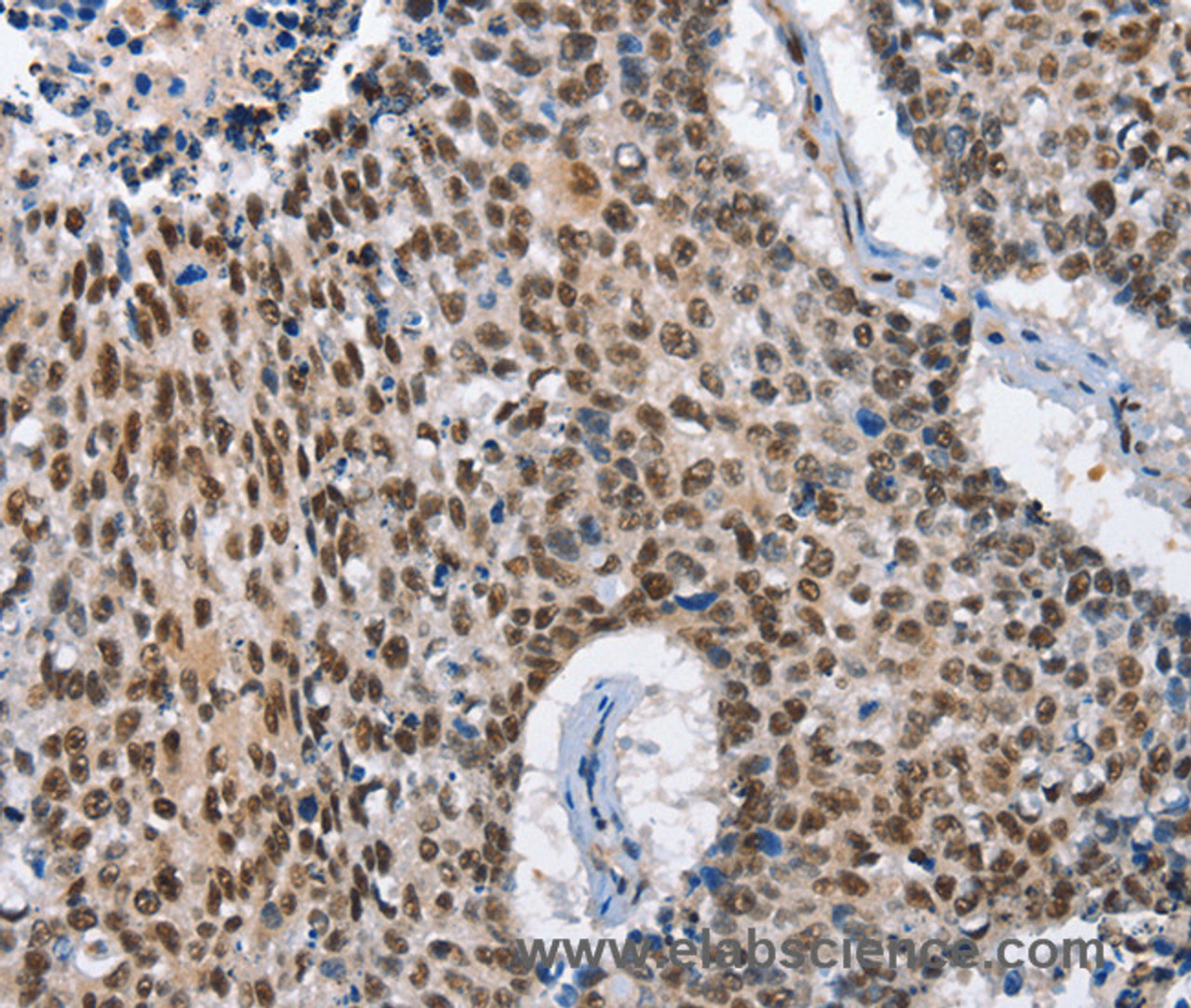 Immunohistochemistry of paraffin-embedded Human lung cancer tissue using GNRH1 Polyclonal Antibody at dilution 1:65