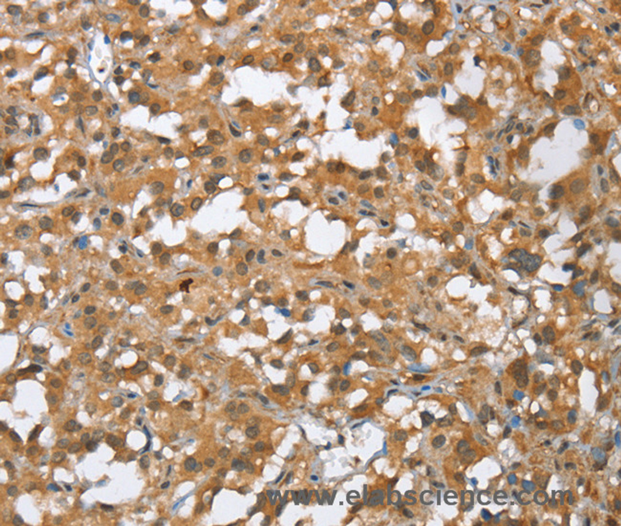 Immunohistochemistry of paraffin-embedded Human thyroid cancer tissue using MMP12 Polyclonal Antibody at dilution of 1:60