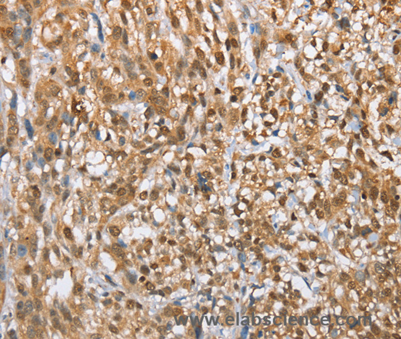 Immunohistochemistry of paraffin-embedded Human esophagus cancer tissue using MMP12 Polyclonal Antibody at dilution of 1:60