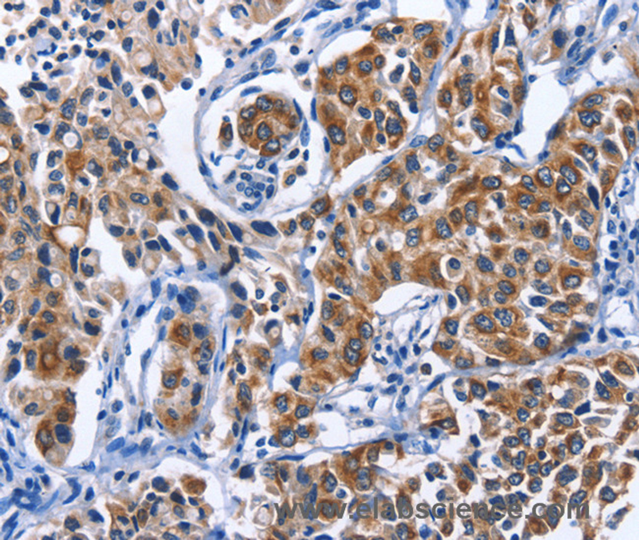 Immunohistochemistry of paraffin-embedded Human lung cancer tissue using MYH1 Polyclonal Antibody at dilution 1:40