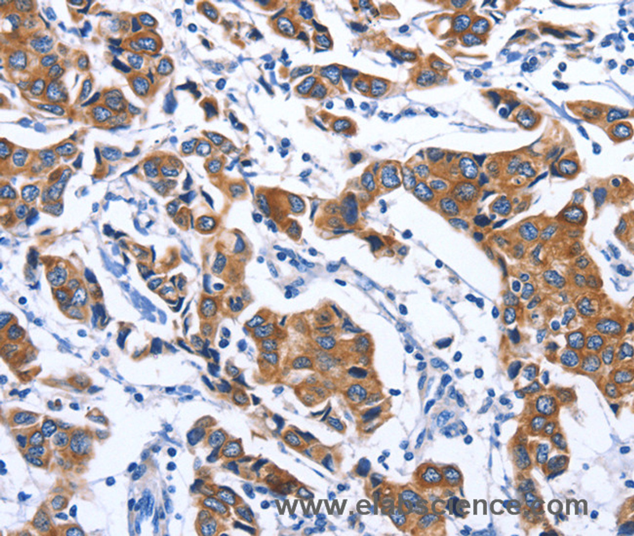 Immunohistochemistry of paraffin-embedded Human breast cancer tissue using MYH1 Polyclonal Antibody at dilution 1:40