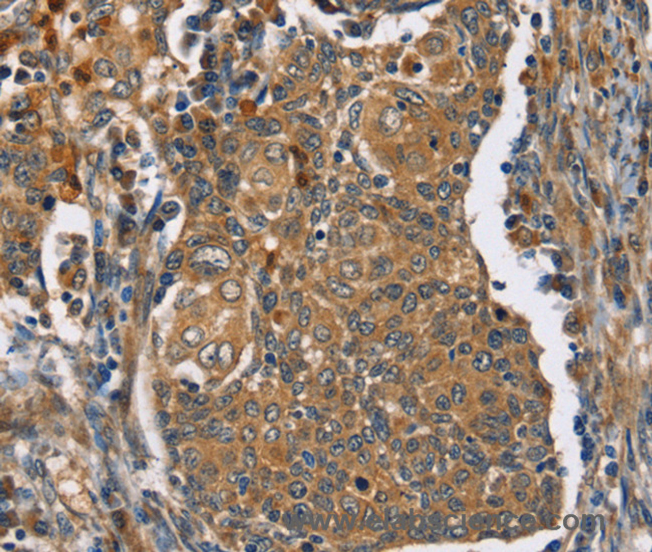 Immunohistochemistry of paraffin-embedded Human cervical cancer tissue using TAC1 Polyclonal Antibody at dilution 1:25