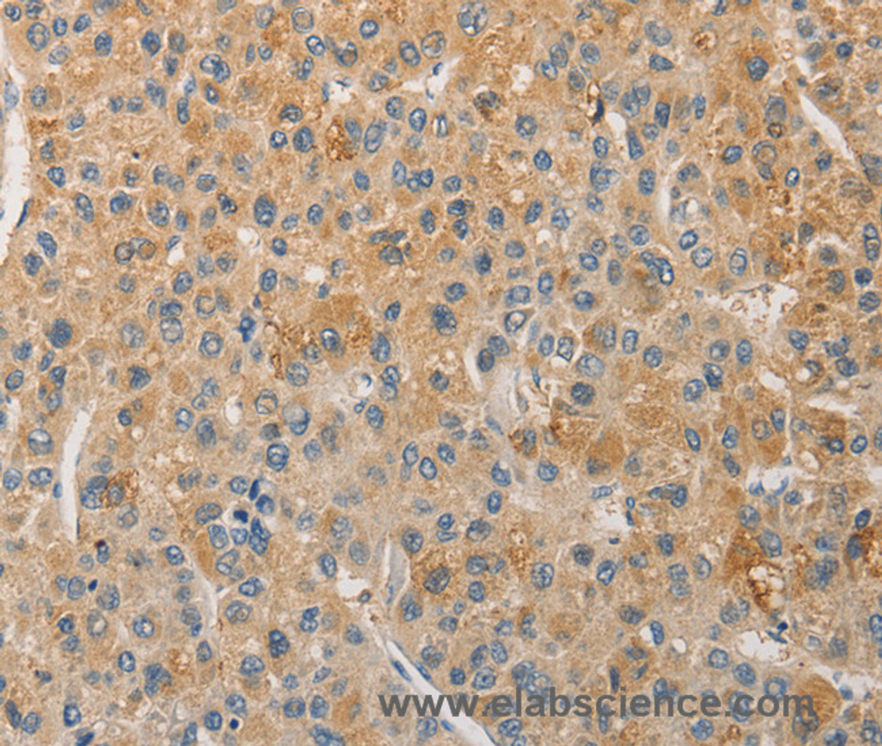 Immunohistochemistry of paraffin-embedded Human liver cancer using NFE2L1 Polyclonal Antibody at dilution of 1:30