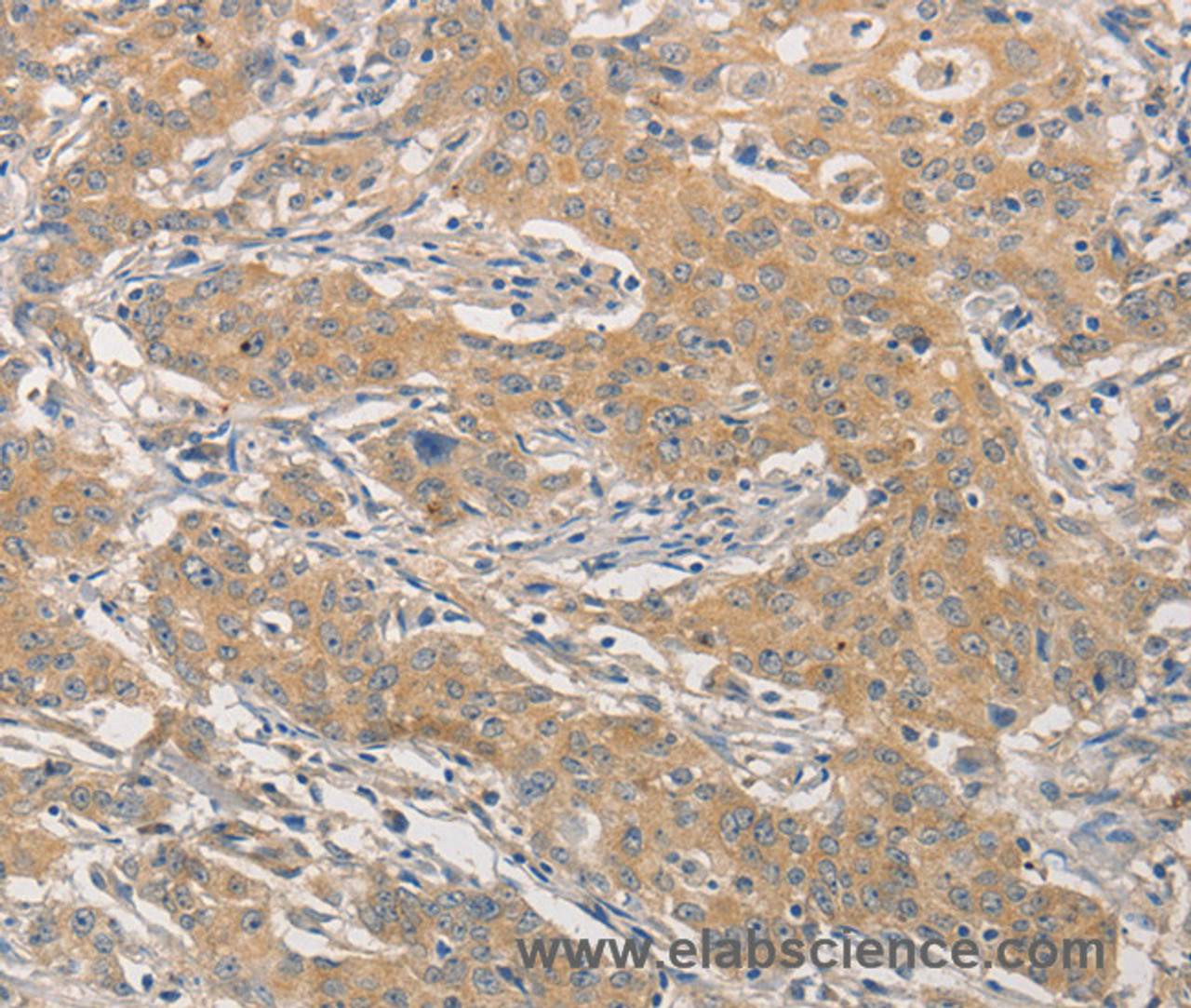 Immunohistochemistry of paraffin-embedded Human gastric cancer using NFE2L1 Polyclonal Antibody at dilution of 1:30