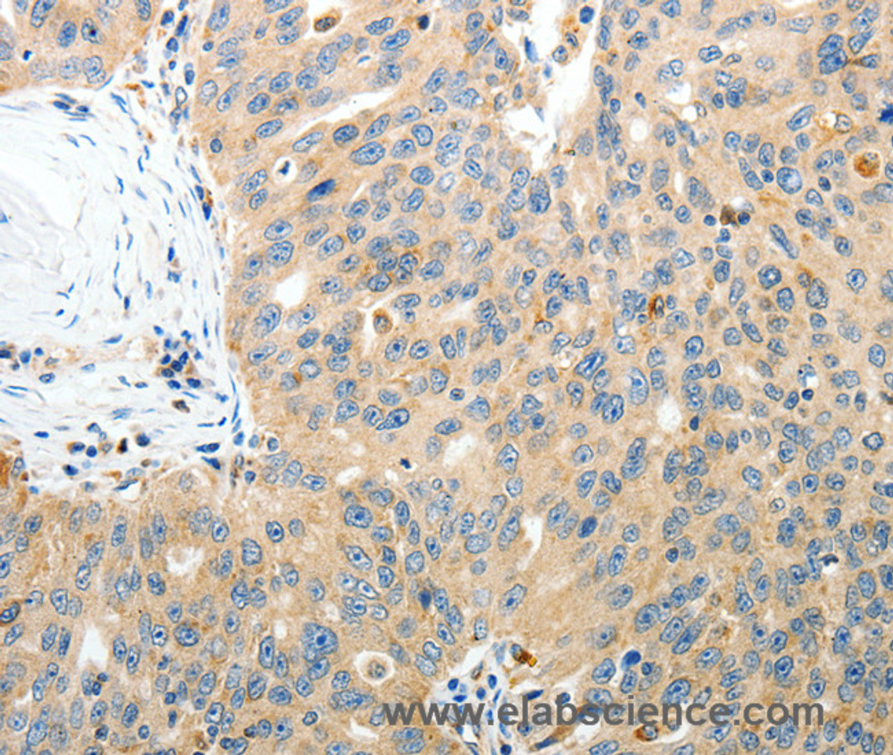 Immunohistochemistry of paraffin-embedded Human ovarian cancer tissue using RAMP3 Polyclonal Antibody at dilution 1:40