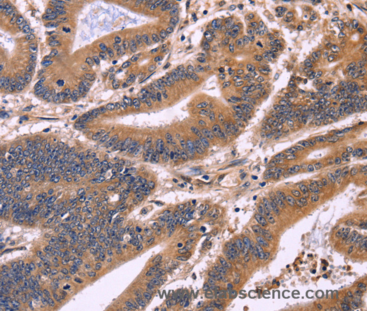 Immunohistochemistry of paraffin-embedded Human colon cancer tissue using S100A13 Polyclonal Antibody at dilution 1:40