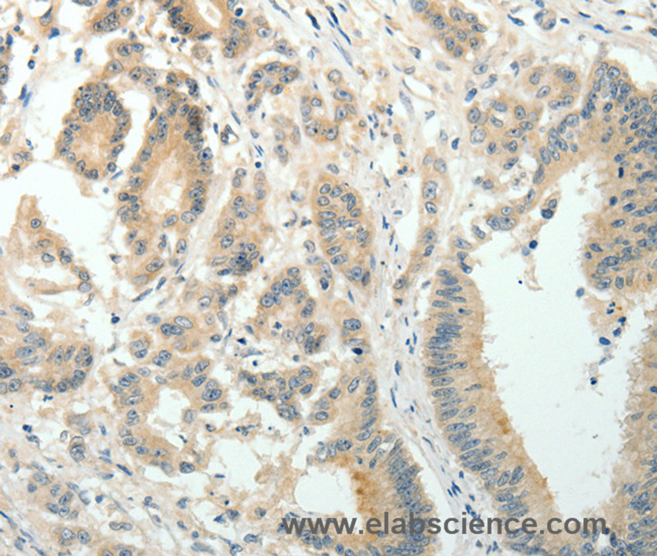 Immunohistochemistry of paraffin-embedded Human colon cancer using SIRT3 Polyclonal Antibody at dilution of 1:30