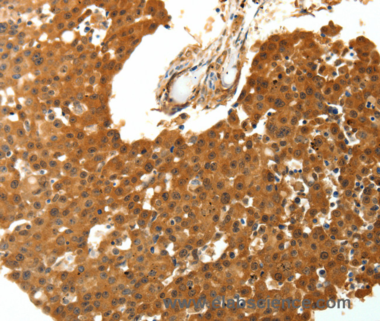 Immunohistochemistry of paraffin-embedded Human breast cancer using SKP1 Polyclonal Antibody at dilution of 1:30