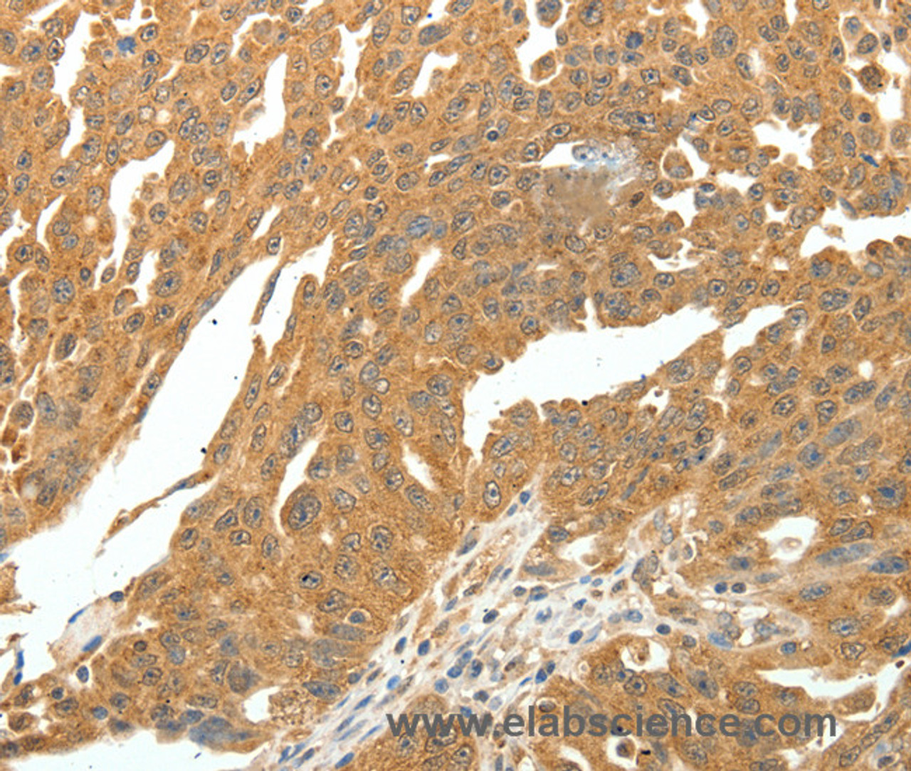 Immunohistochemistry of paraffin-embedded Human ovarian cancer using SKP1 Polyclonal Antibody at dilution of 1:30