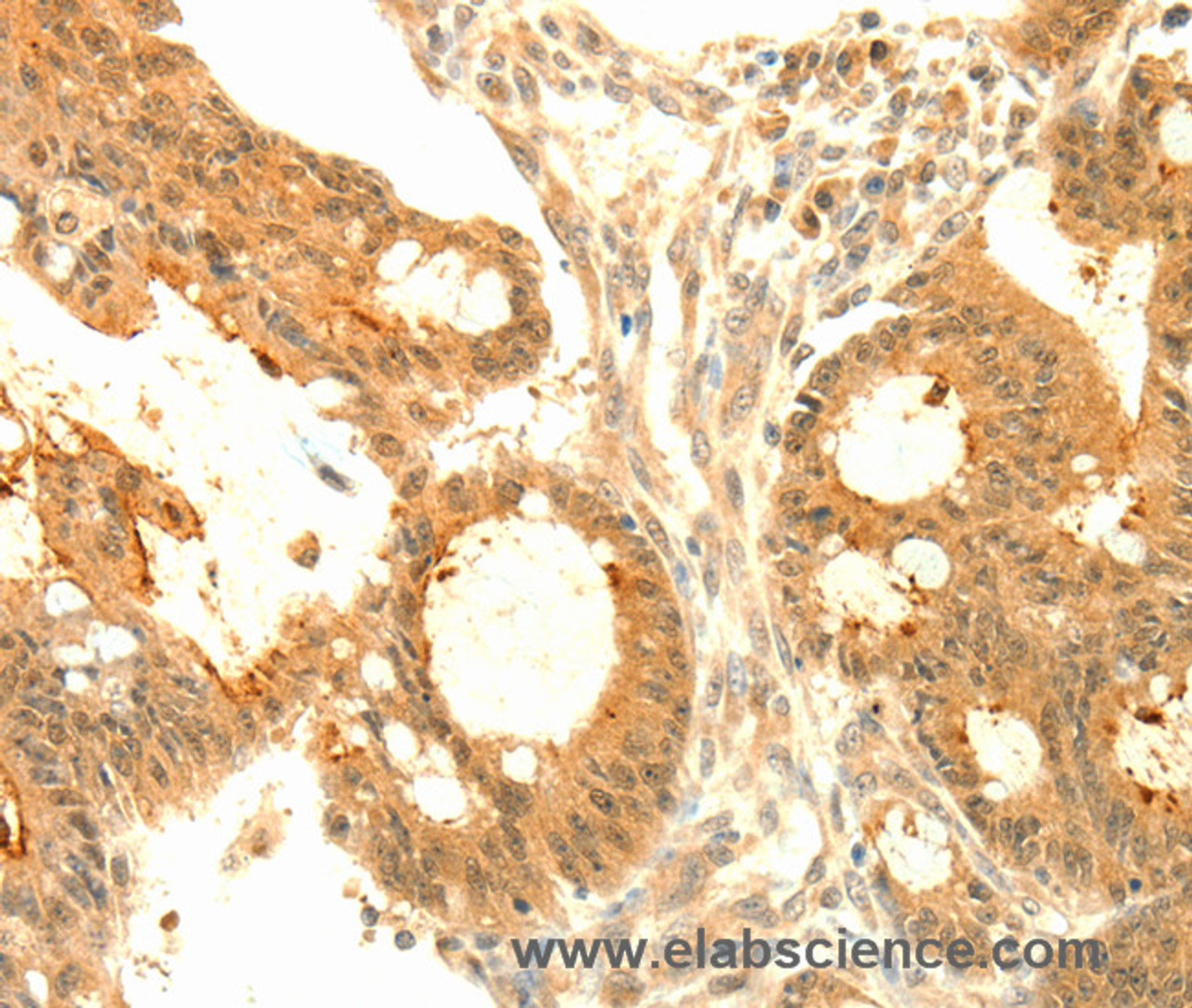 Immunohistochemistry of paraffin-embedded Human colon cancer tissue using SOCS6 Polyclonal Antibody at dilution 1:50