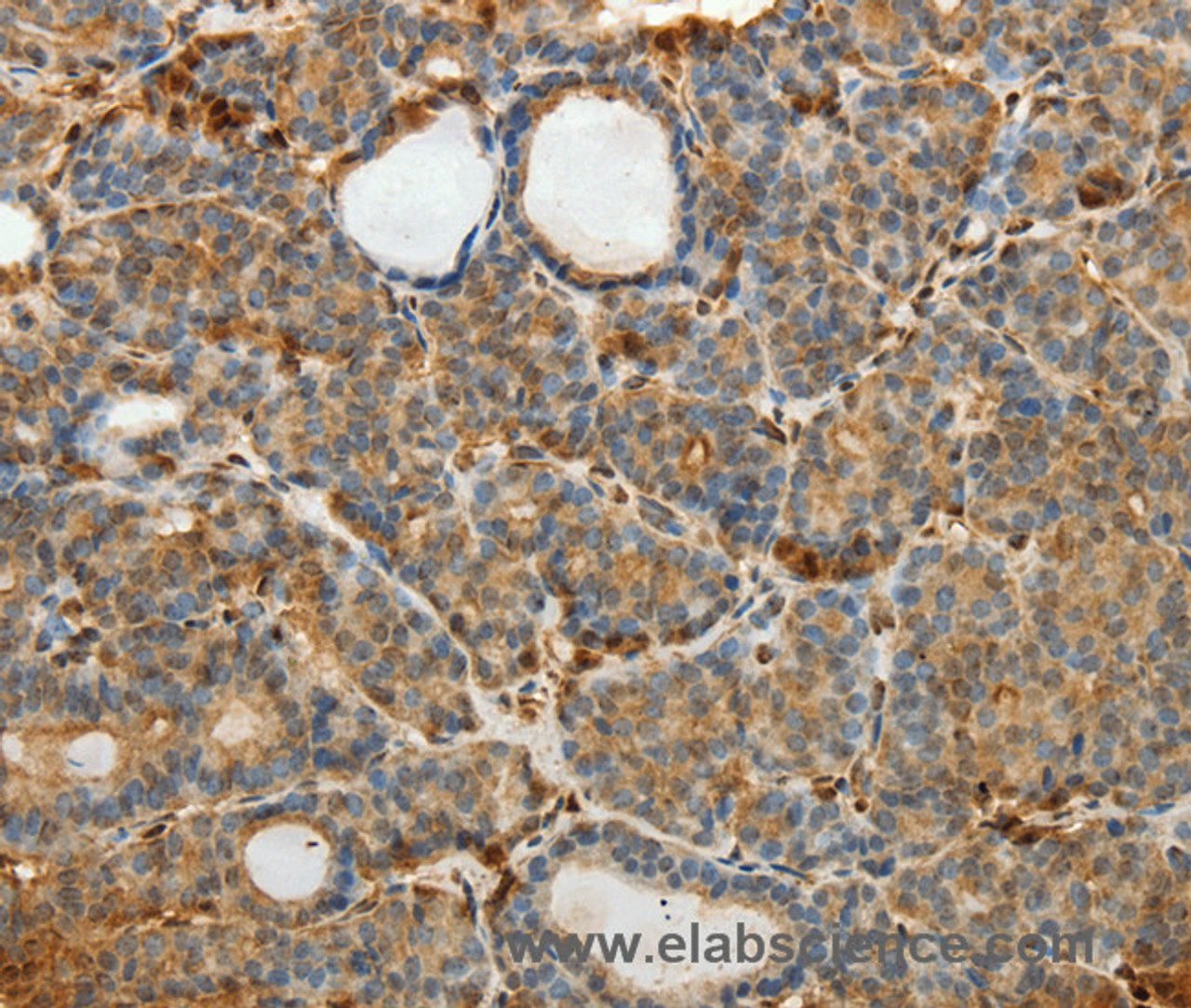Immunohistochemistry of paraffin-embedded Human thyroid cancer using SULT1E1 Polyclonal Antibody at dilution of 1:30