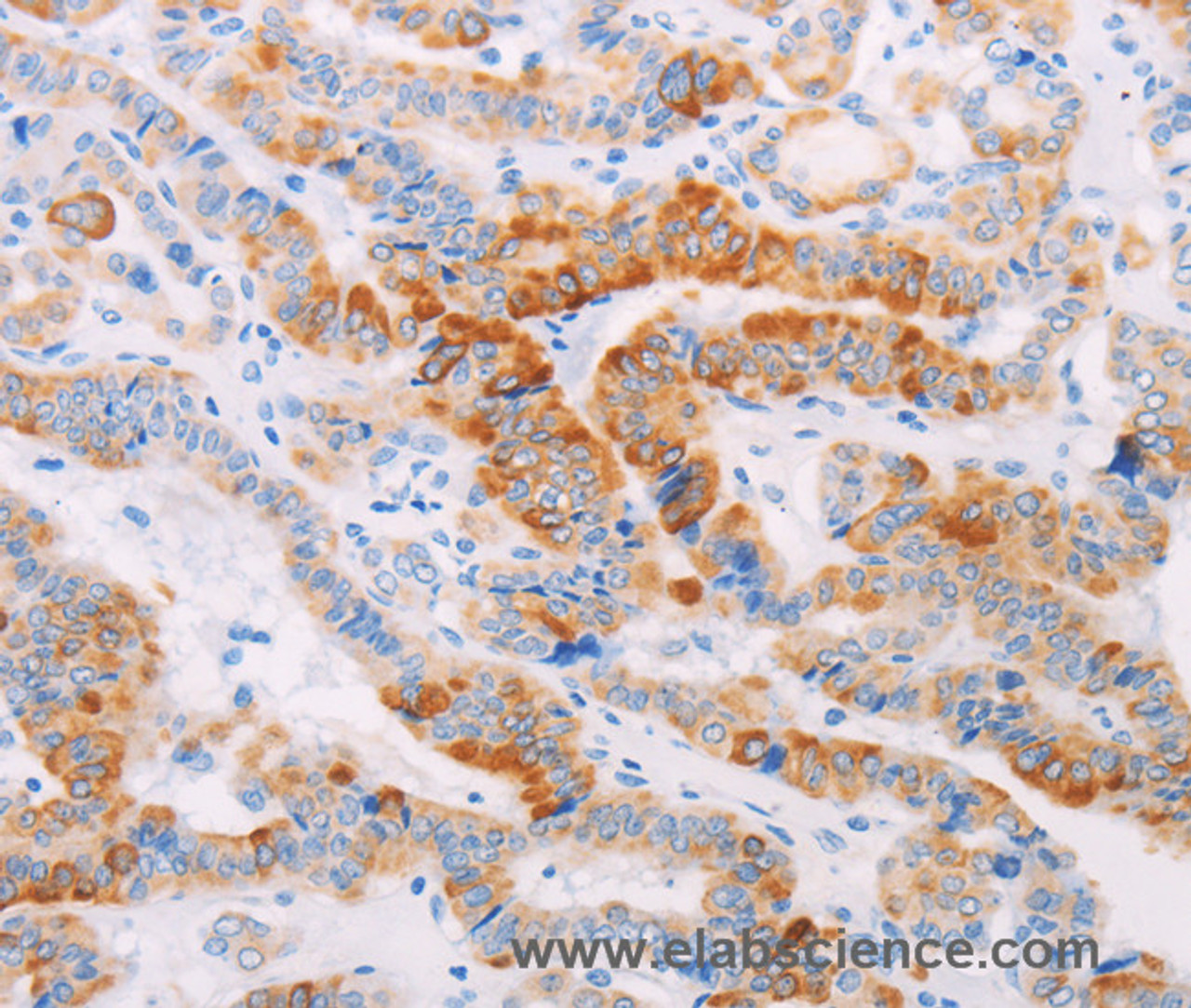 Immunohistochemistry of paraffin-embedded Human thyroid cancer using MAP4K3 Polyclonal Antibody at dilution of 1:30