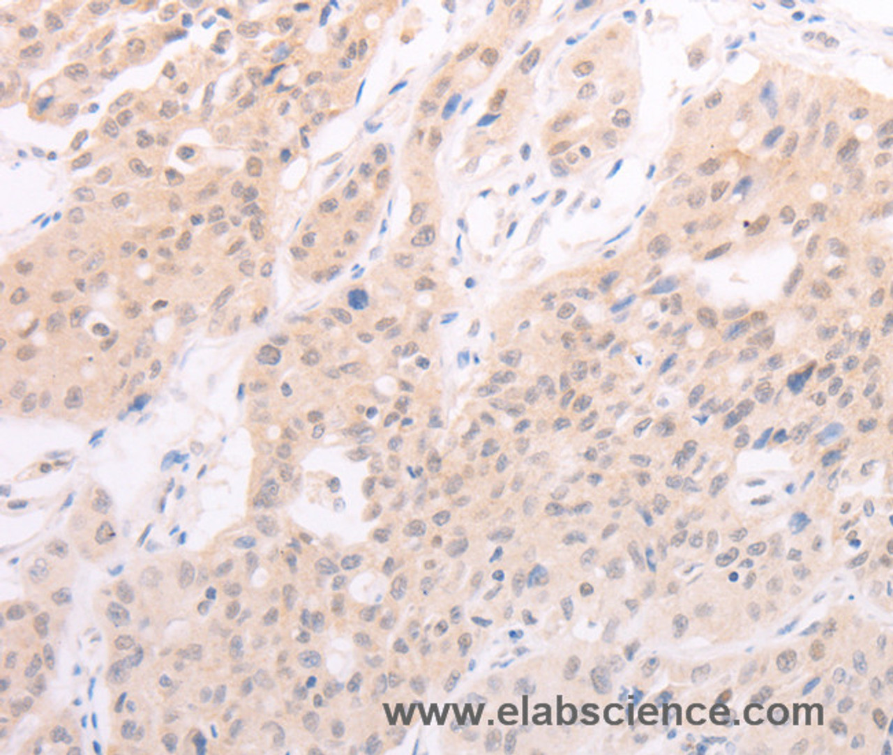 Immunohistochemistry of paraffin-embedded Human lung cancer using F7 Polyclonal Antibody at dilution of 1:40