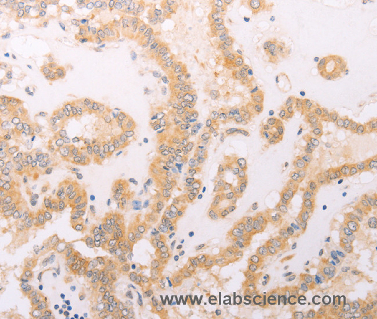 Immunohistochemistry of paraffin-embedded Human thyroid cancer using F7 Polyclonal Antibody at dilution of 1:40
