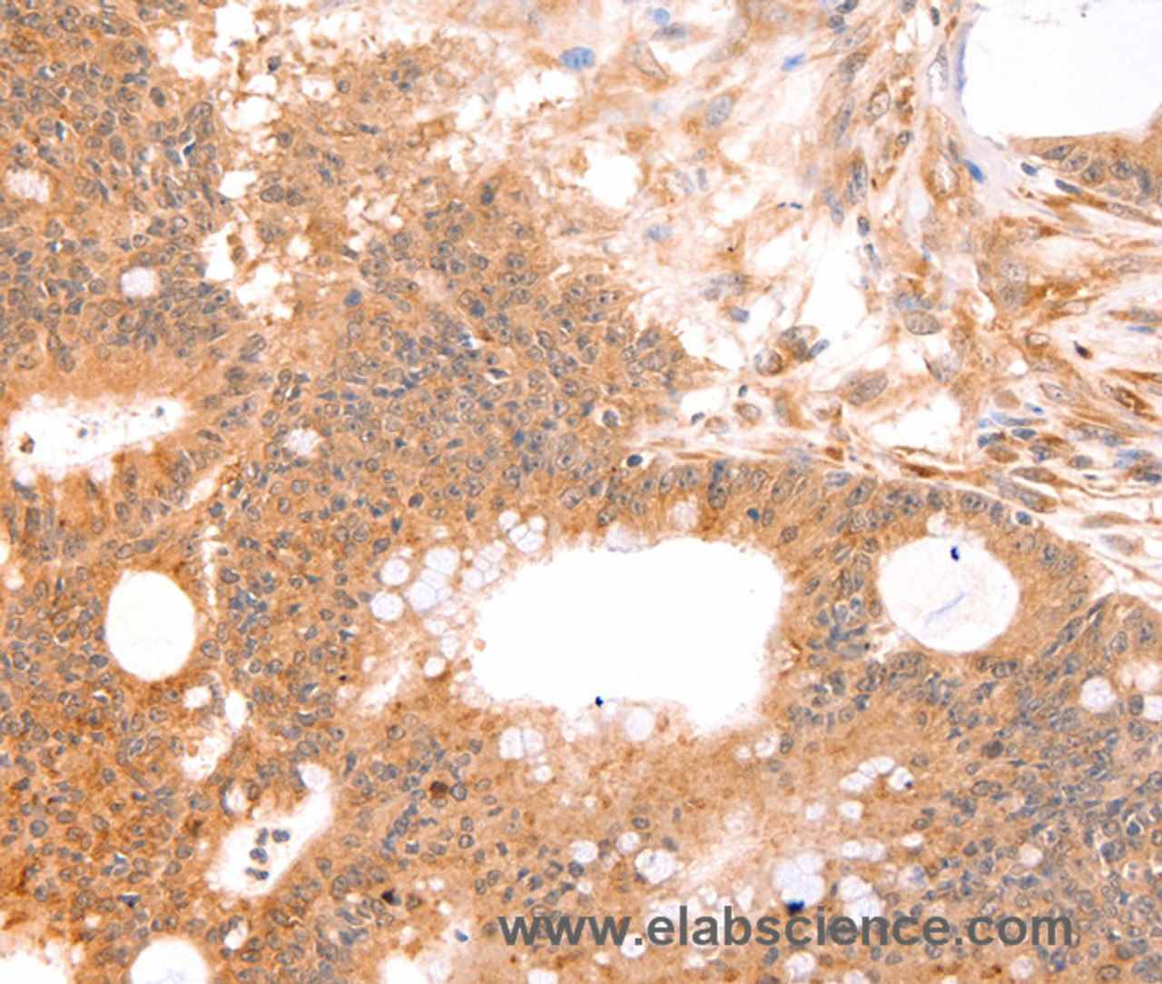 Immunohistochemistry of paraffin-embedded Human colon cancer tissue using TNF beta Polyclonal Antibody at dilution 1:50